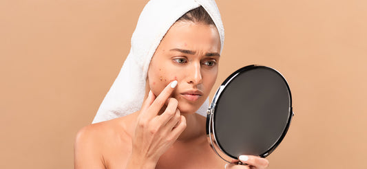 The science behind acne breakouts and acne management